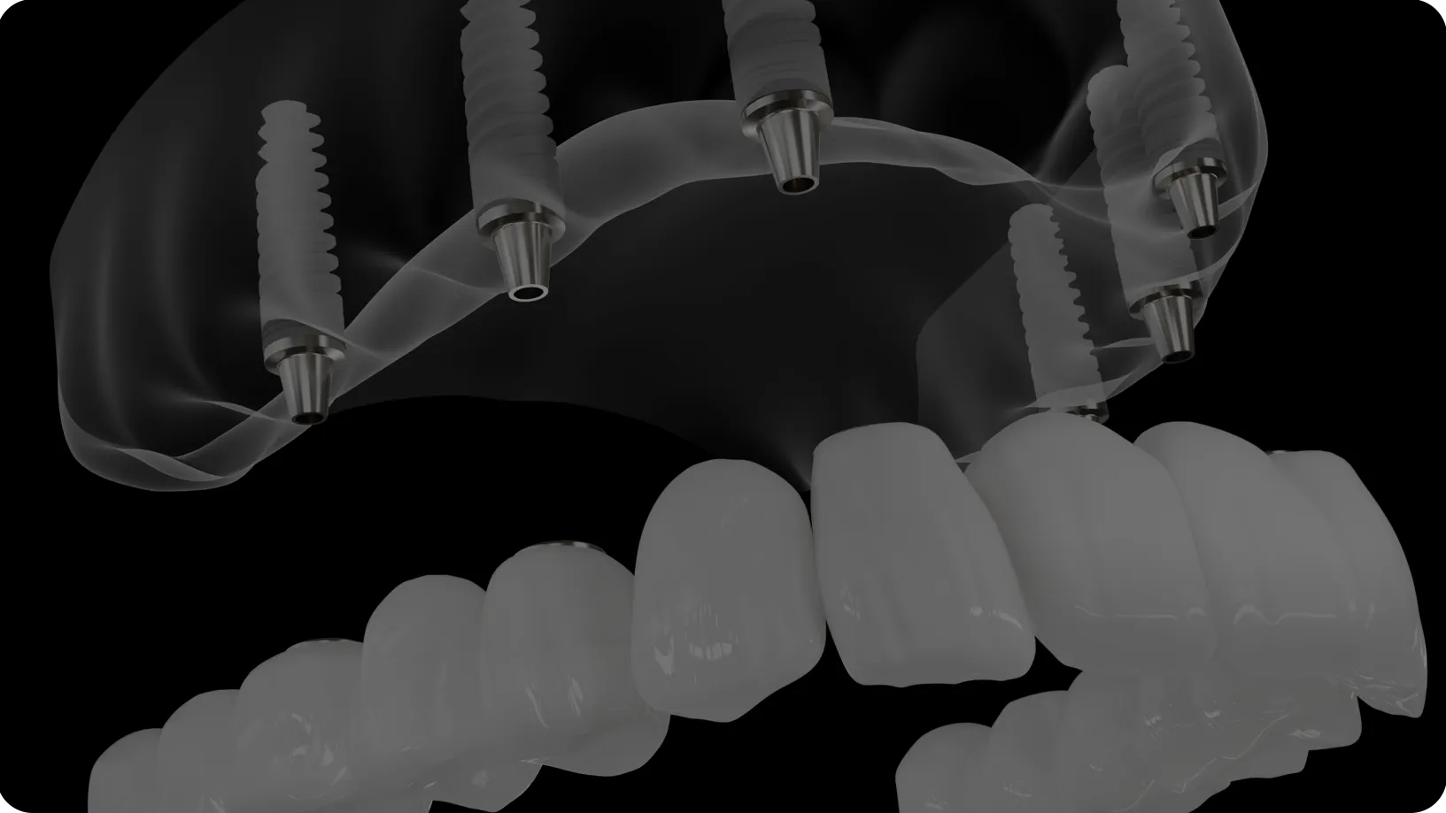 Black and white illustration of a zirconia full arch dental restoration.